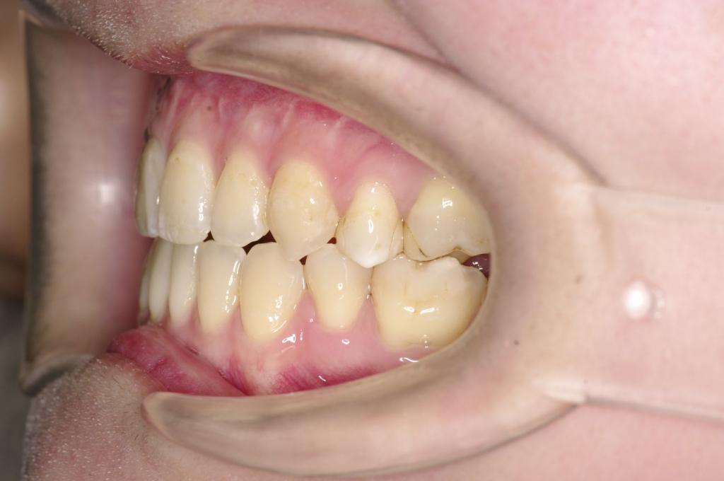 顎、顔の歪みの矯正治療後口内写真NO.518
