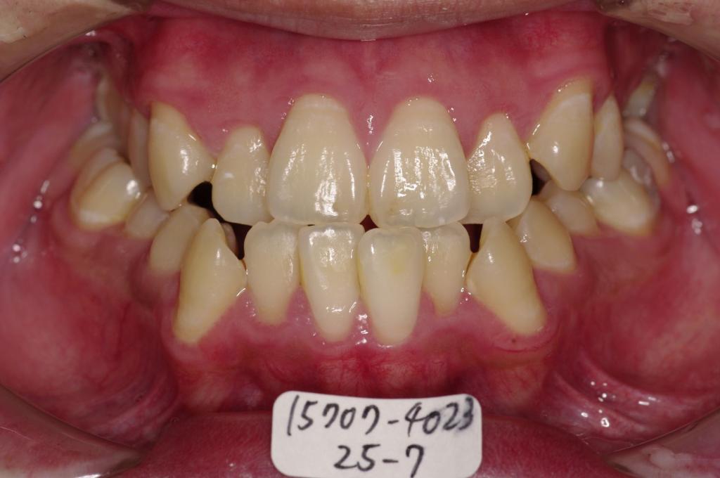 顎、顔の歪みの矯正治療前口内写真NO.519