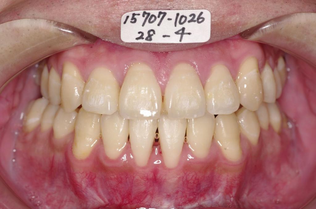 顎、顔の歪みの矯正治療後口内写真NO.519