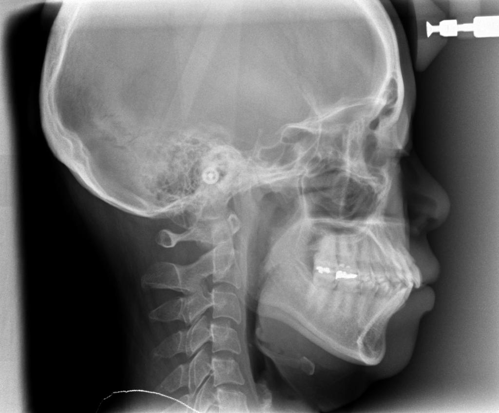 顎、顔の歪みの矯正治療前口内写真NO.521