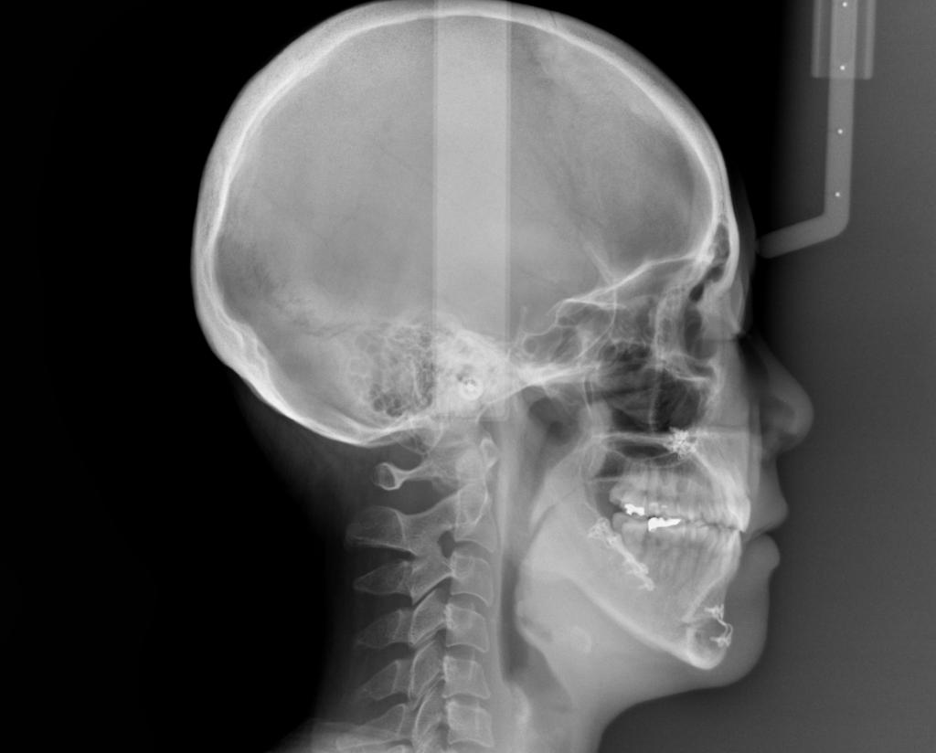 顎、顔の歪みの矯正治療後口内写真NO.521