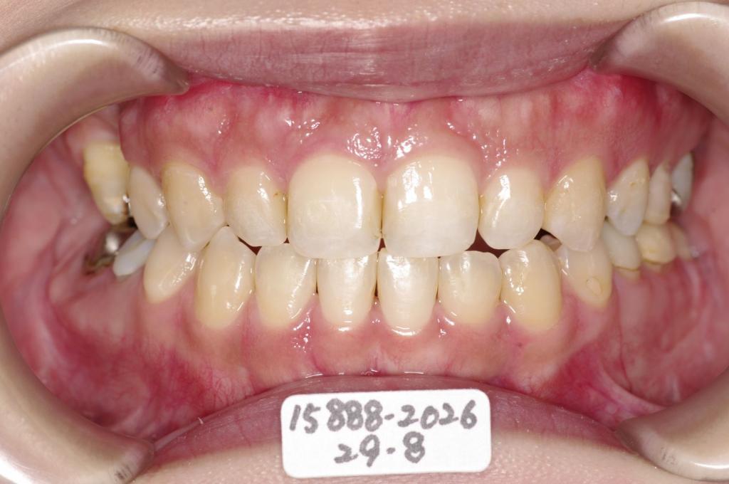 顎、顔の歪みの矯正治療後口内写真NO.522