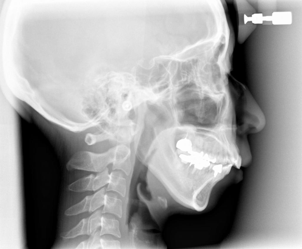 顎、顔の歪みの矯正治療前口内写真NO.523