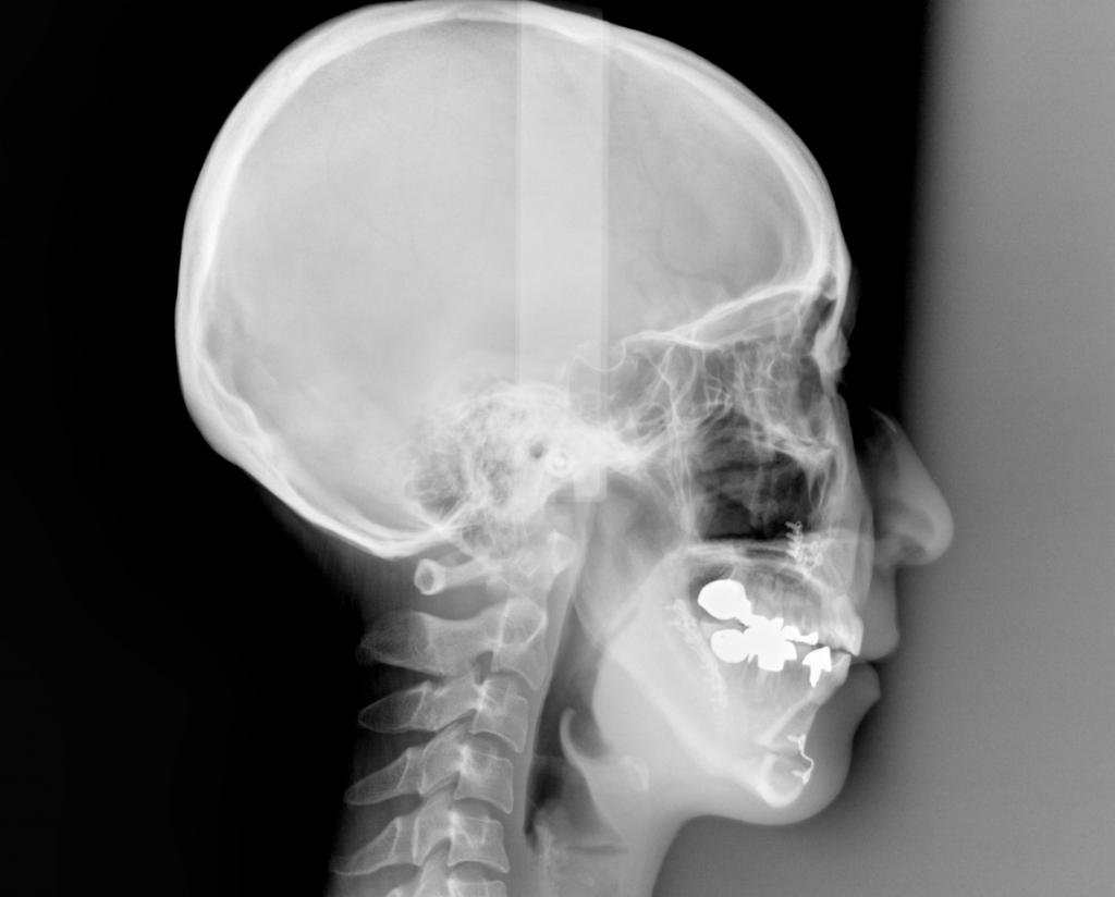 顎、顔の歪みの矯正治療後口内写真NO.523