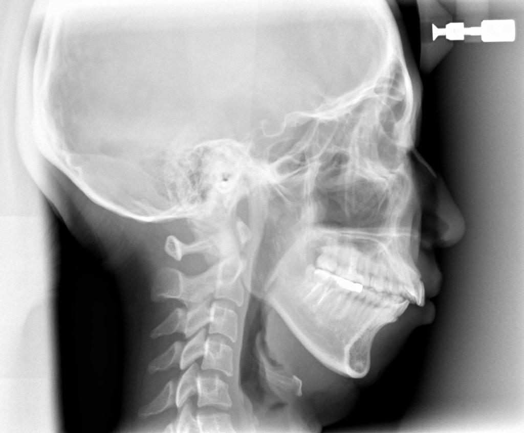 顎、顔の歪みの矯正治療前口内写真NO.524