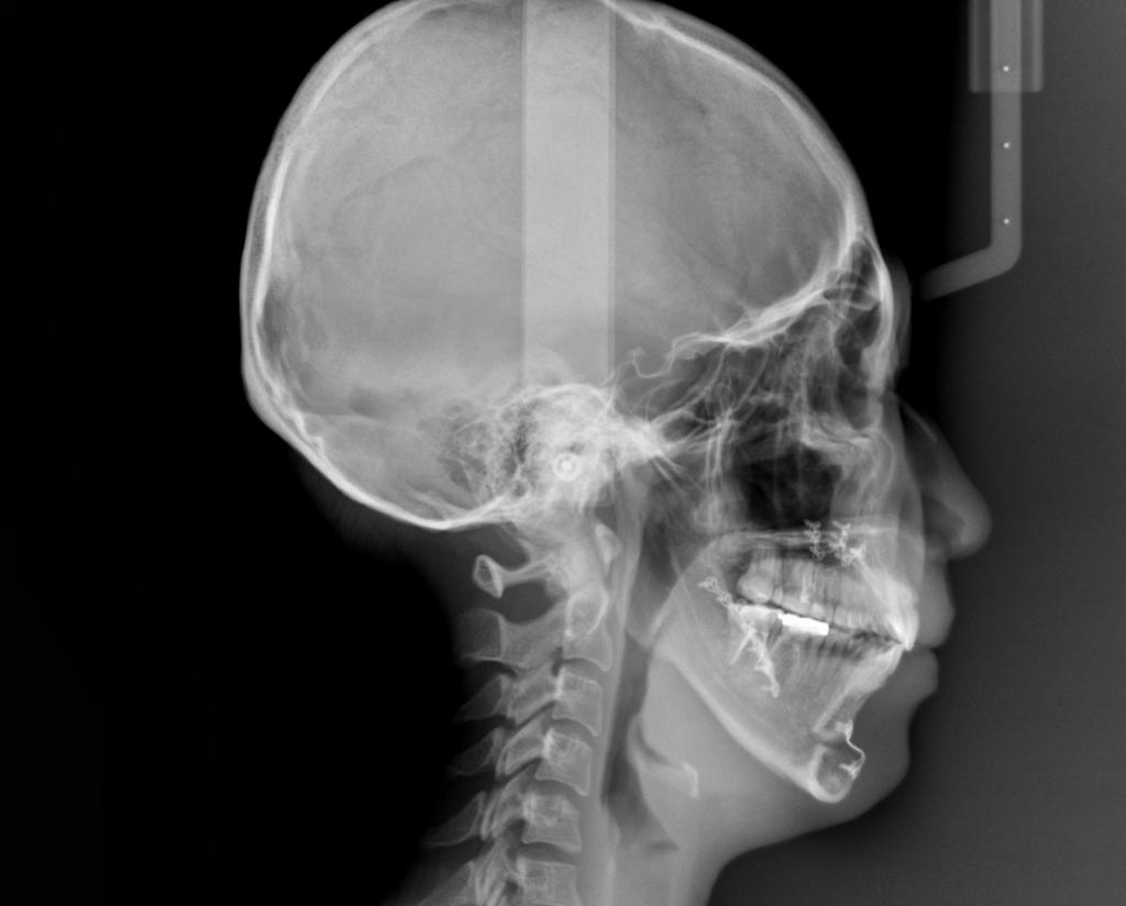 顎、顔の歪みの矯正治療後口内写真NO.524