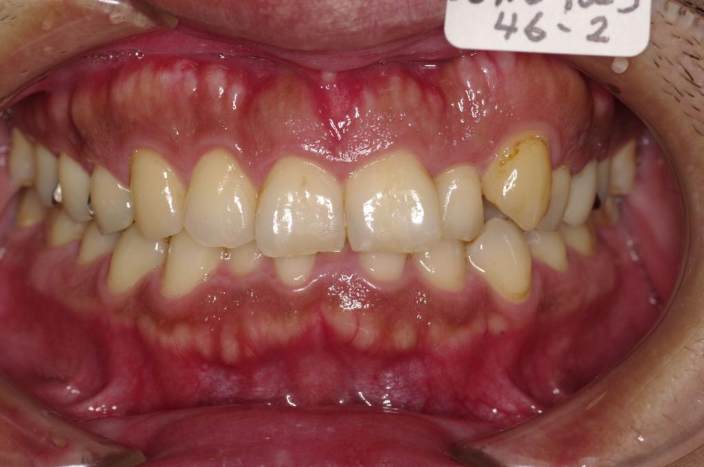 顎、顔の歪みの矯正治療前口内写真NO.525