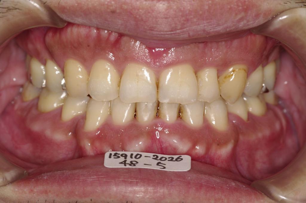 顎、顔の歪みの矯正治療後口内写真NO.525