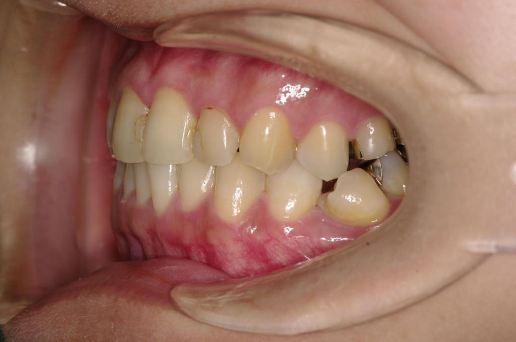 顎、顔の歪みの矯正治療前口内写真NO.526