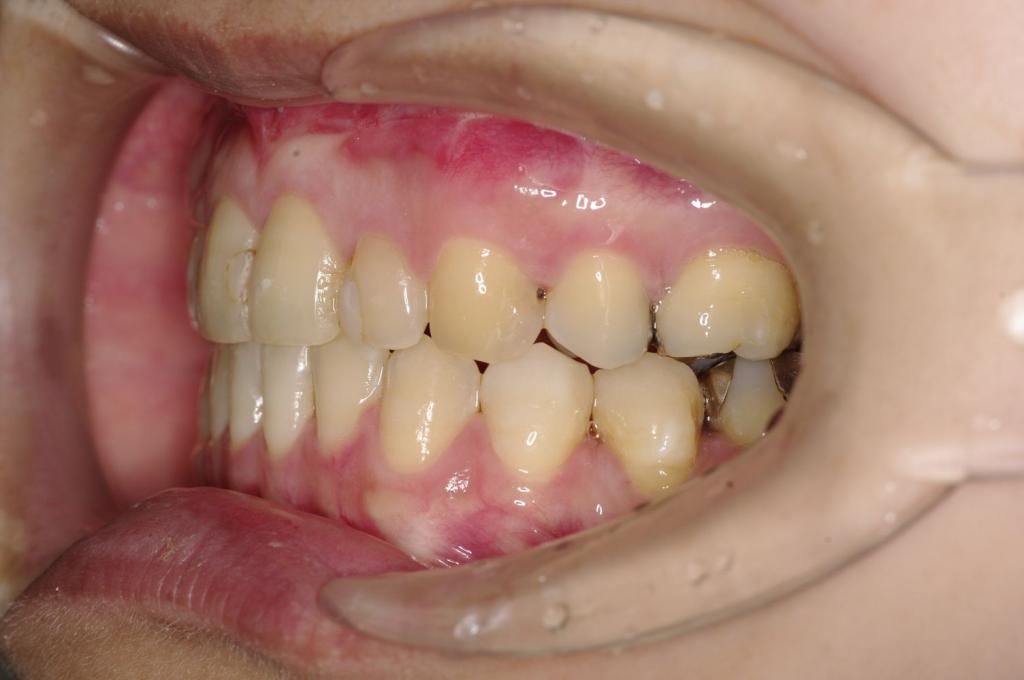 顎、顔の歪みの矯正治療後口内写真NO.526