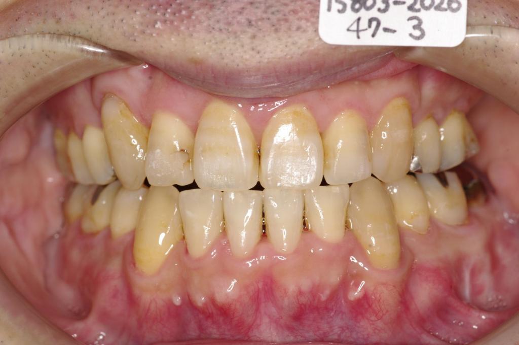 顎、顔の歪みの矯正治療後口内写真NO.527