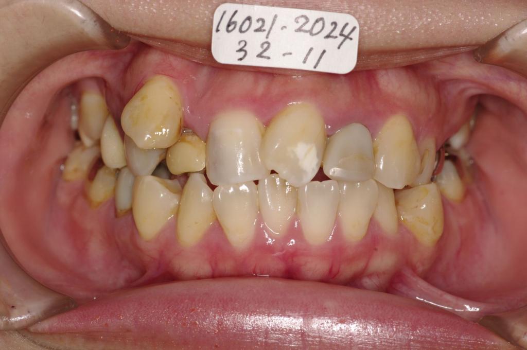 顎、顔の歪みの矯正治療前口内写真NO.528