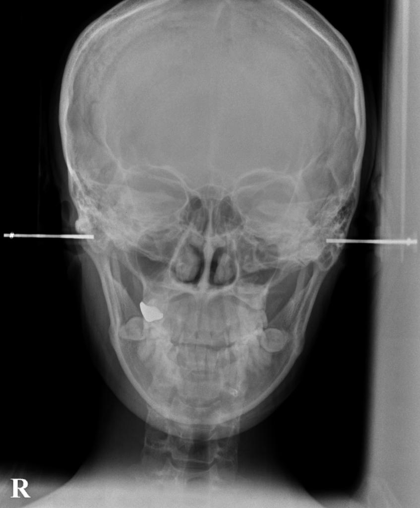 顎、顔の歪みの矯正治療前口内写真NO.529