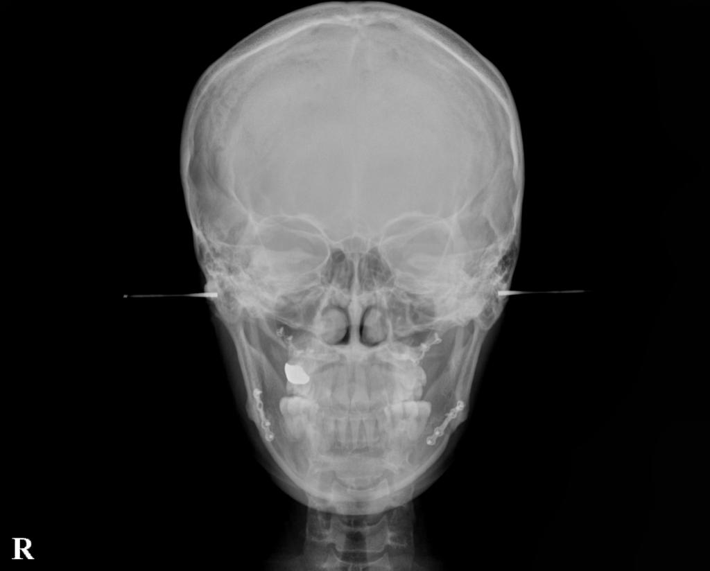 顎、顔の歪みの矯正治療後口内写真NO.529