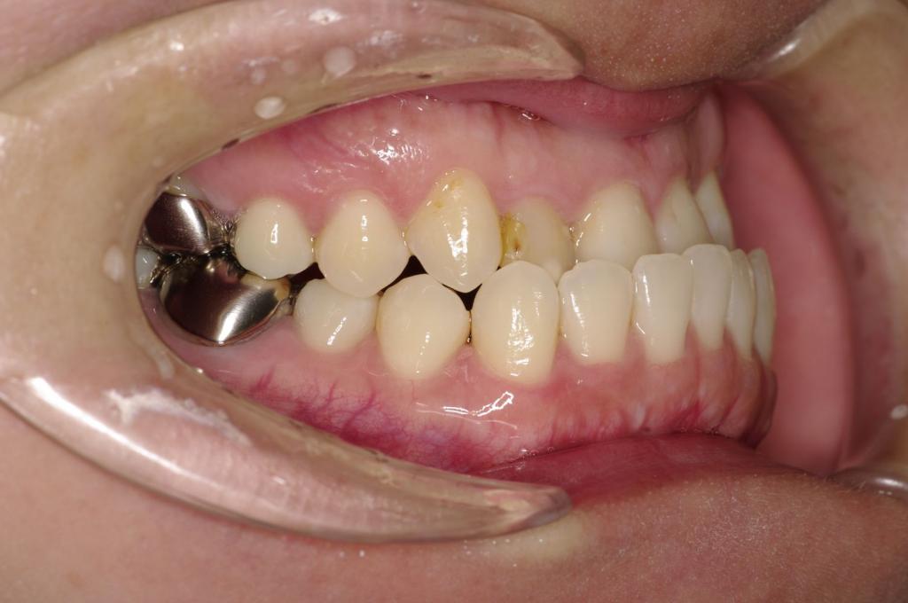 顎、顔の歪みの矯正治療前口内写真NO.530