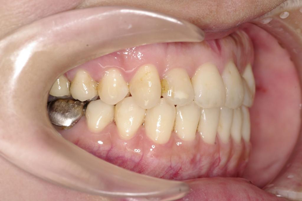 顎、顔の歪みの矯正治療後口内写真NO.530