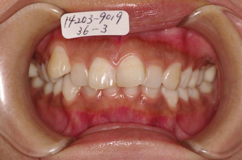 歯欠損の矯正治療前口内写真NO.112