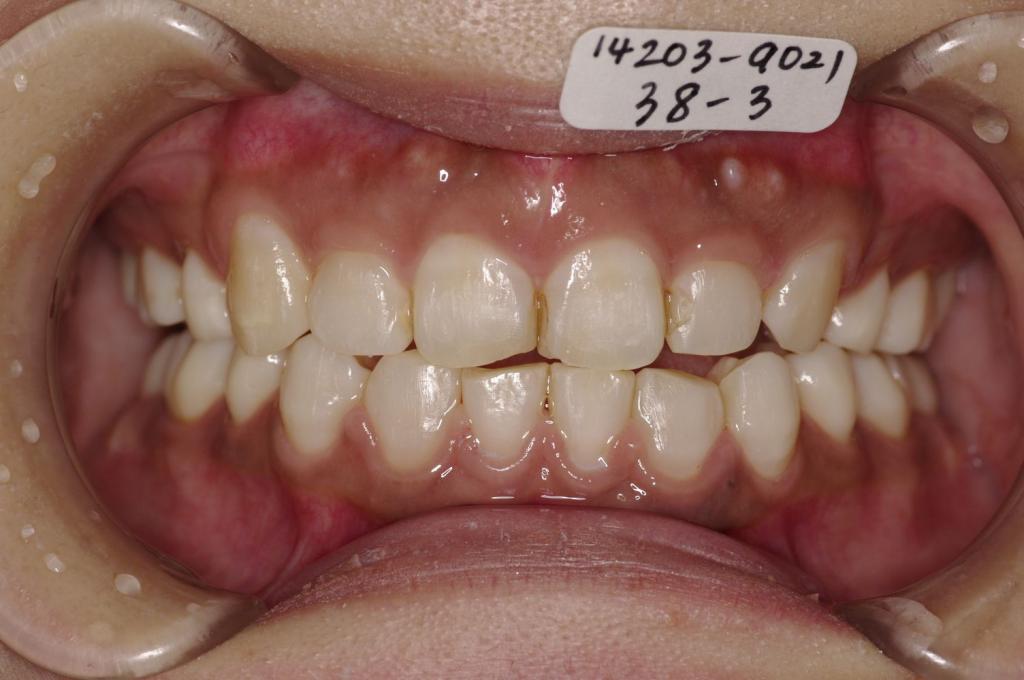 歯欠損の矯正治療後口内写真NO.112