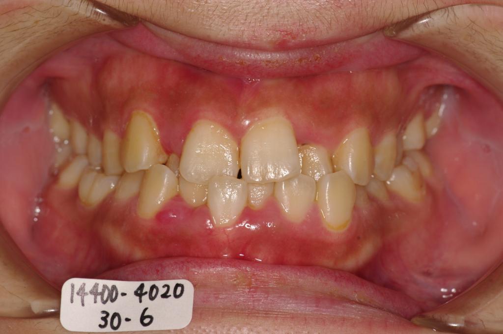 歯欠損の矯正治療前口内写真NO.113