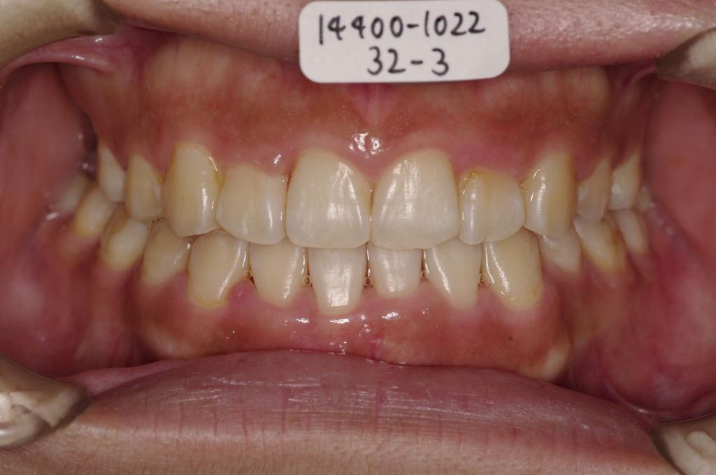 歯欠損の矯正治療後口内写真NO.113