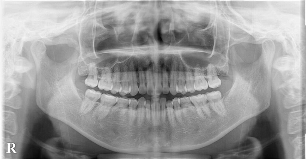 歯欠損の矯正治療前口内写真NO.114