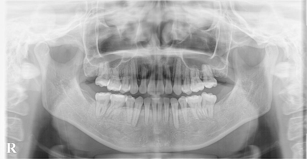 歯欠損の矯正治療後口内写真NO.114