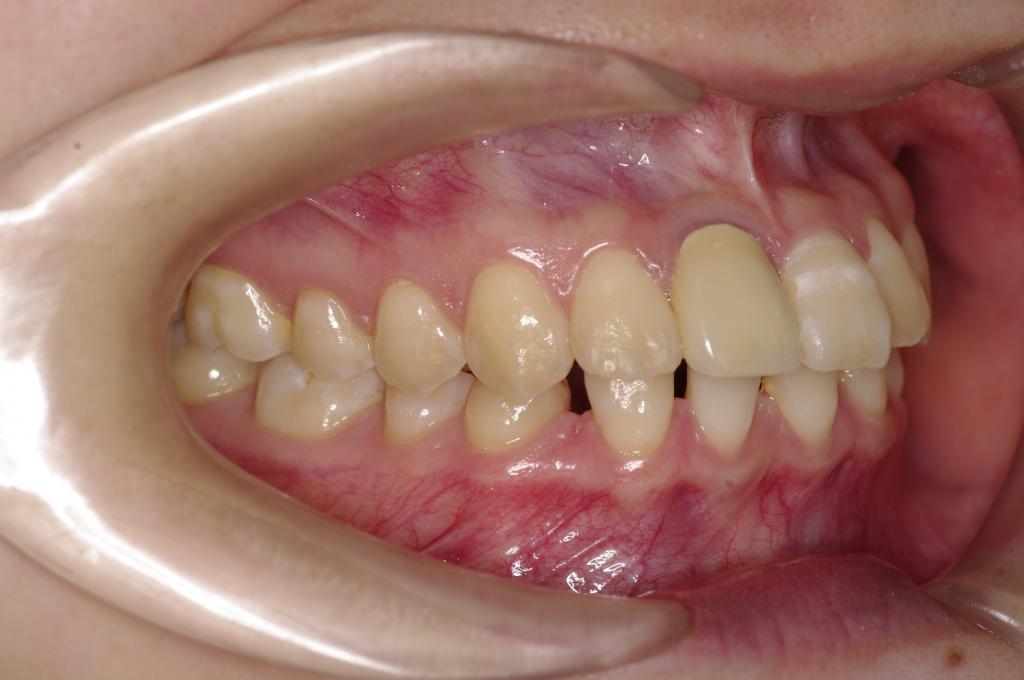 歯欠損の矯正治療前口内写真NO.115