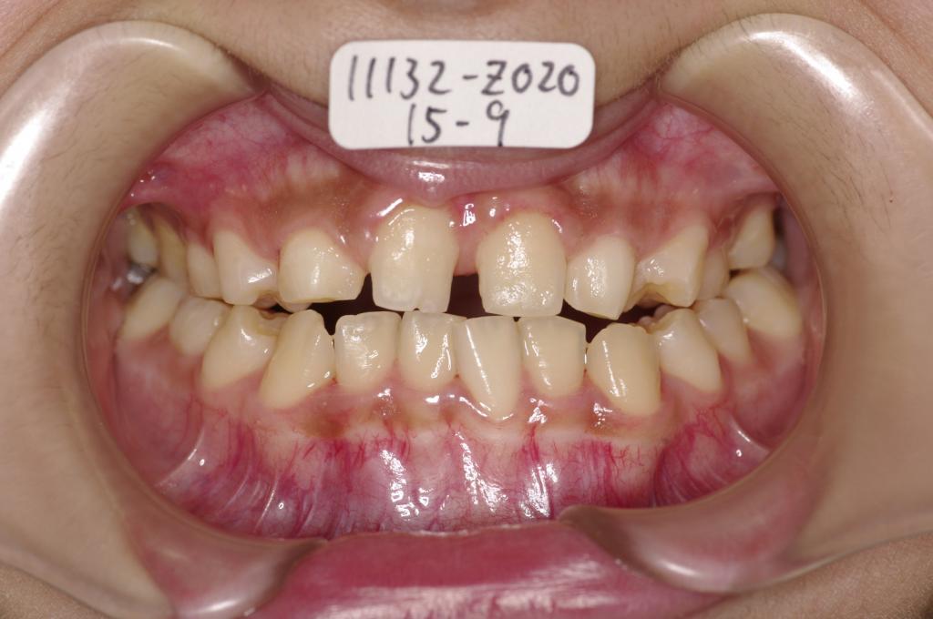 歯欠損の矯正治療前口内写真NO.116