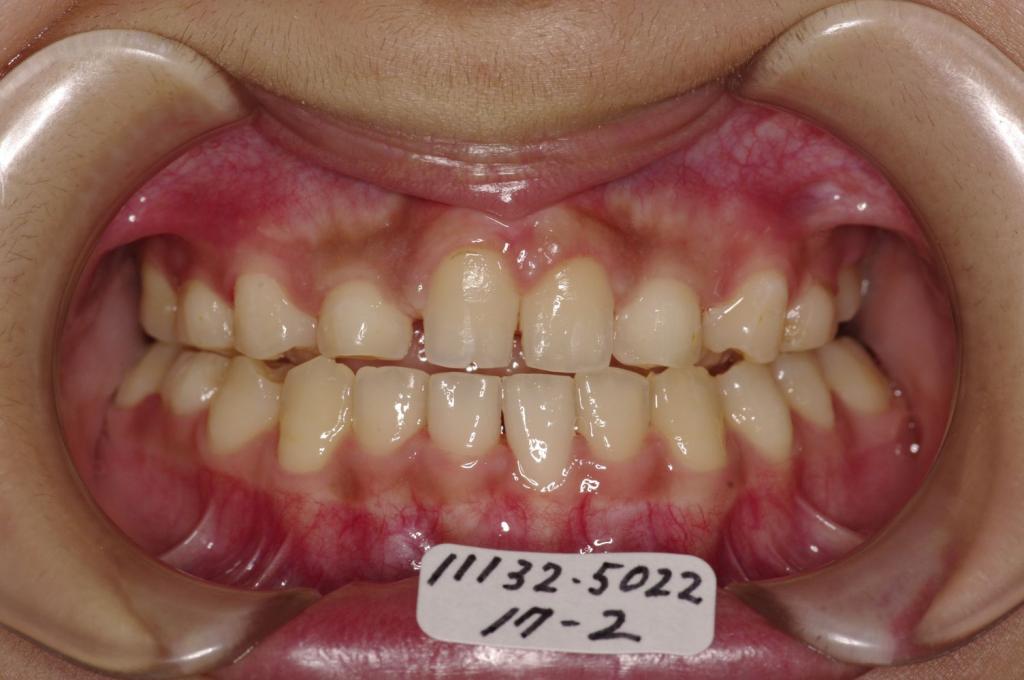 歯欠損の矯正治療後口内写真NO.116