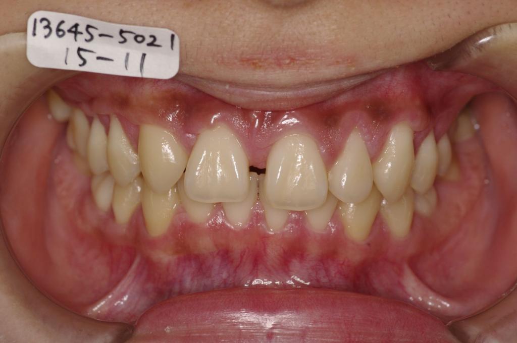 歯欠損の矯正治療前口内写真NO.117