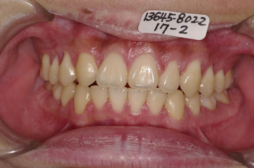歯欠損の矯正治療後口内写真NO.117