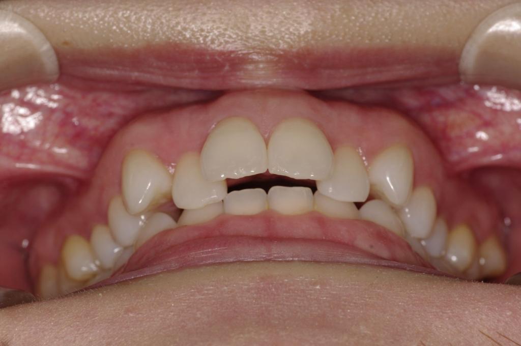 歯欠損の矯正治療前口内写真NO.118