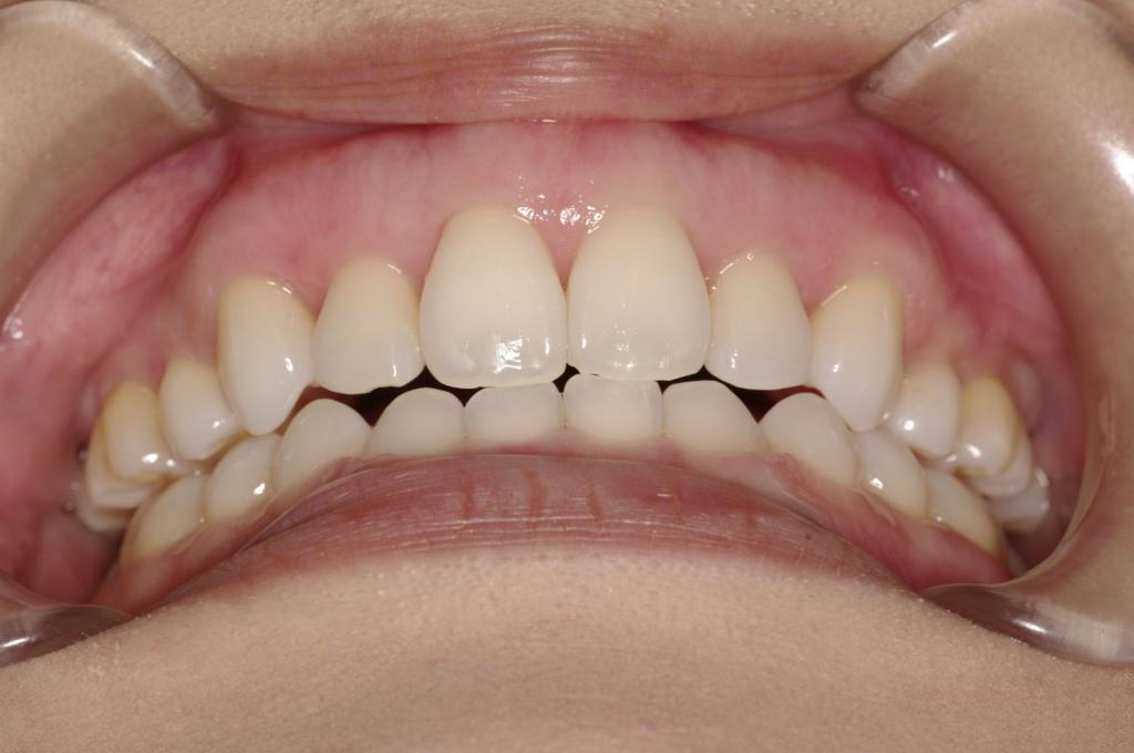 歯欠損の矯正治療後口内写真NO.118