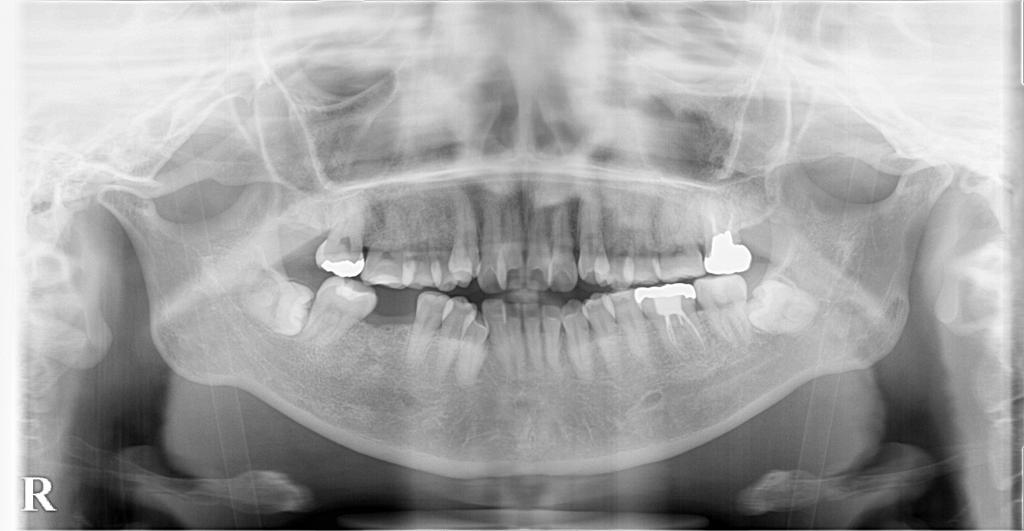 歯欠損の矯正治療前口内写真NO.119