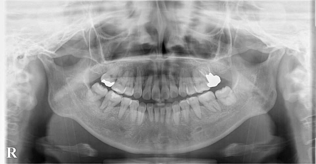 歯欠損の矯正治療後口内写真NO.119