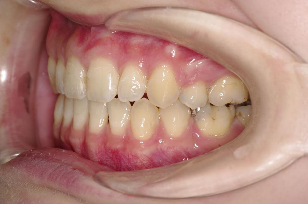 歯欠損の矯正治療後口内写真NO.120