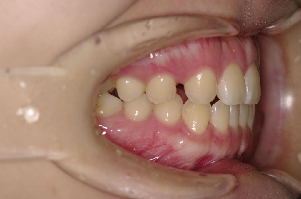 歯欠損の矯正治療前口内写真NO.121