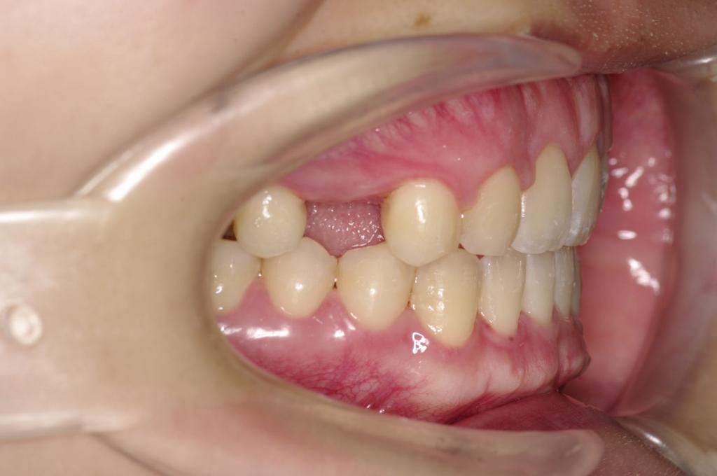 歯欠損の矯正治療後口内写真NO.121