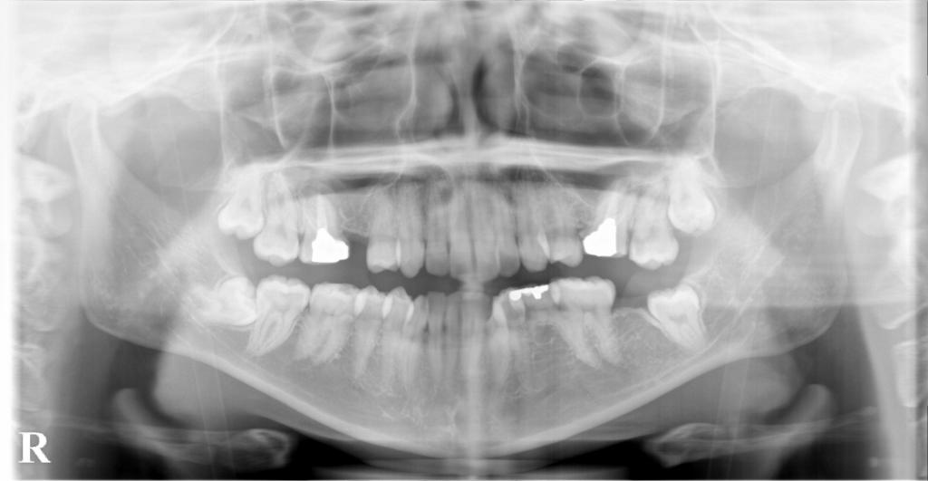 歯欠損の矯正治療前口内写真NO.122
