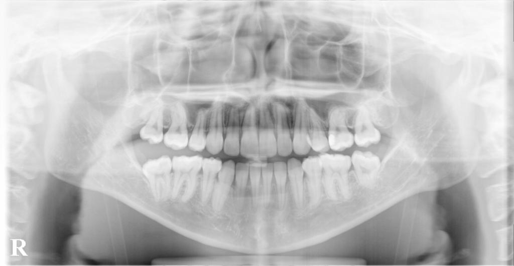 歯欠損の矯正治療後口内写真NO.122