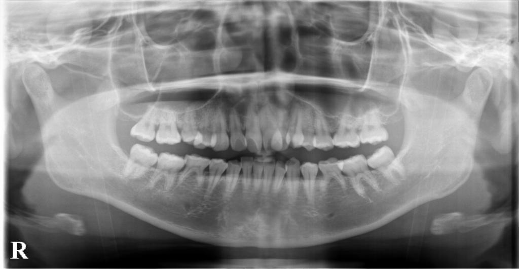歯欠損の矯正治療前口内写真NO.123