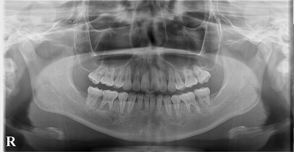 歯欠損の矯正治療後口内写真NO.123
