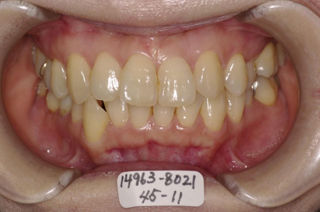 歯欠損の矯正治療前口内写真NO.125
