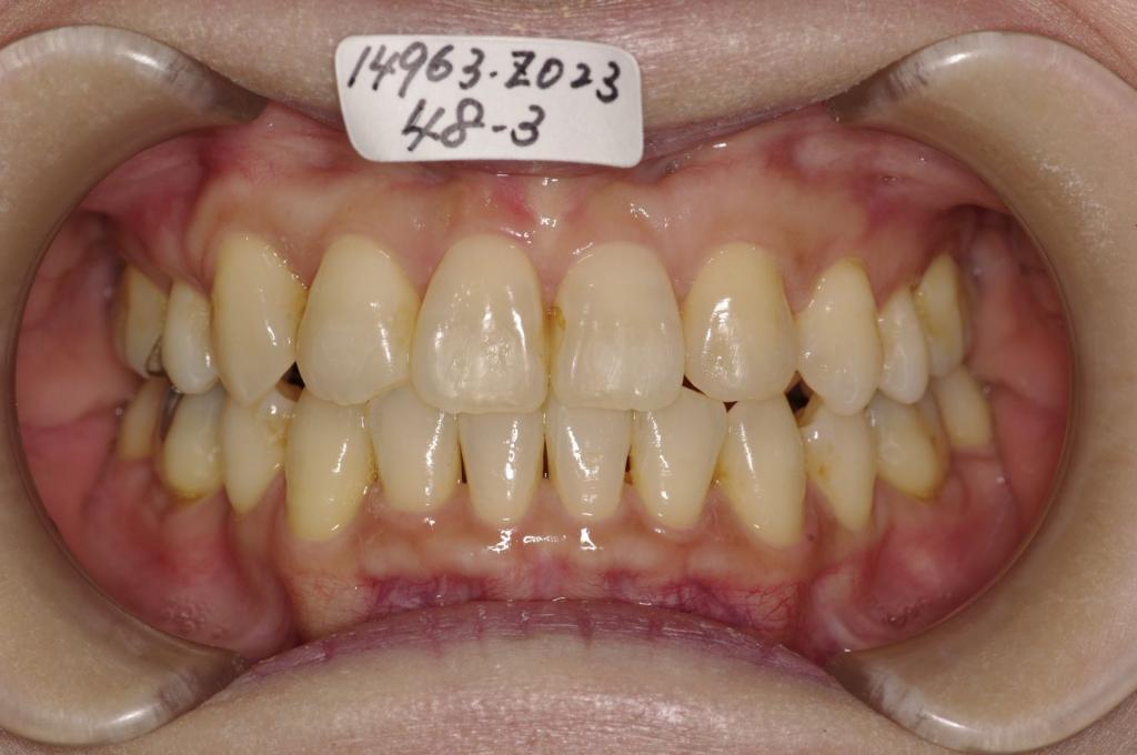 歯欠損の矯正治療後口内写真NO.125