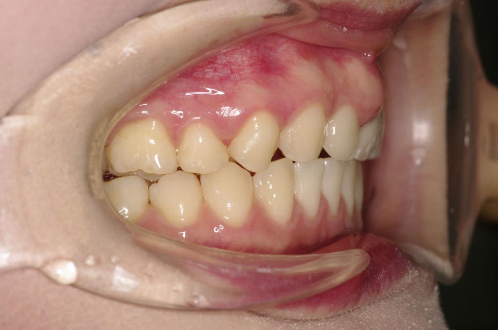 歯欠損の矯正治療後口内写真NO.126
