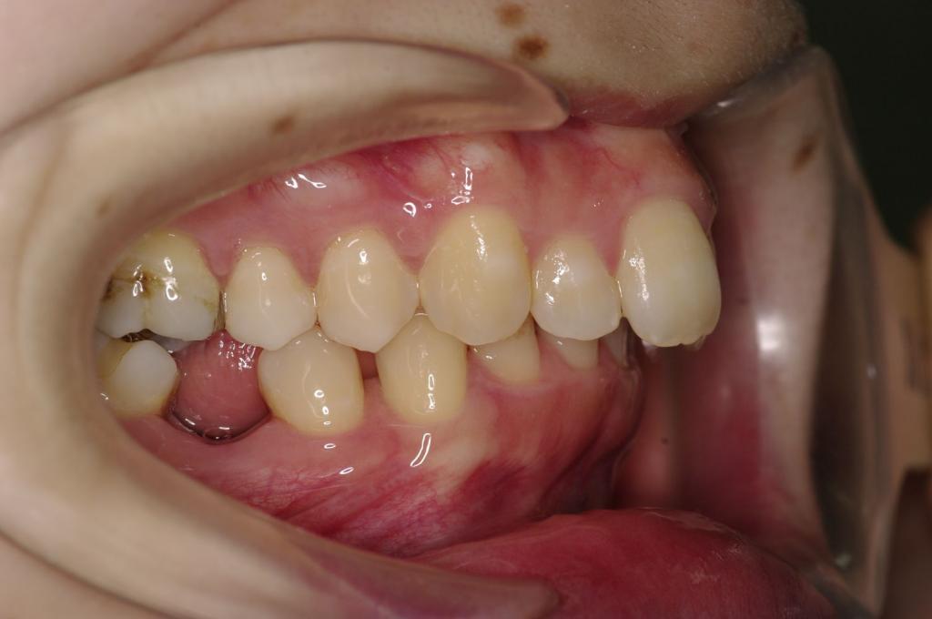 歯欠損の矯正治療前口内写真NO.127