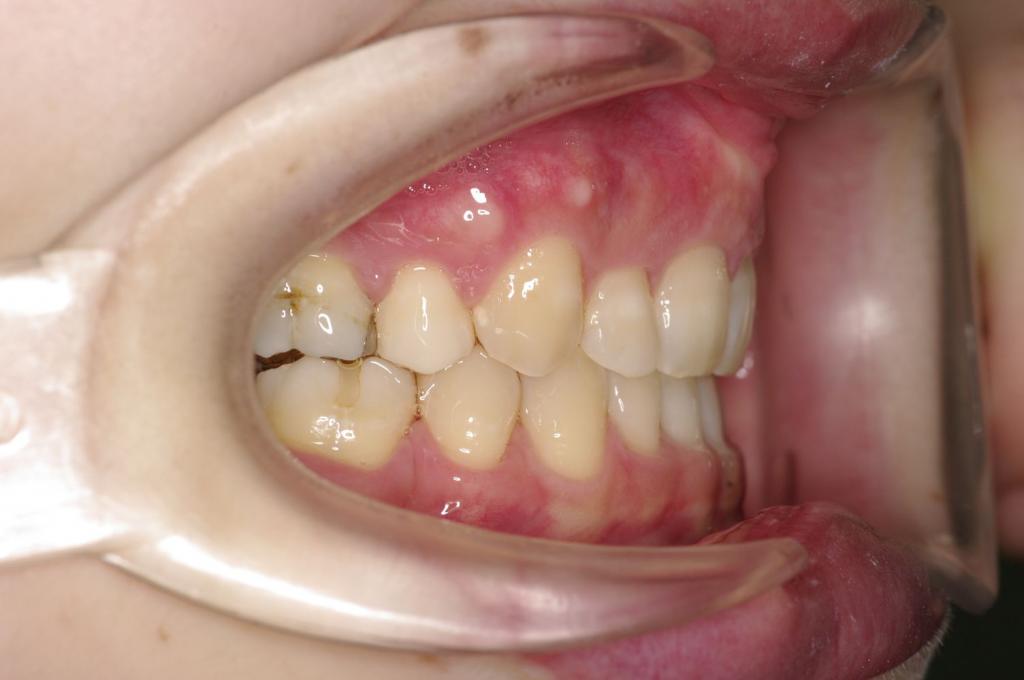 歯欠損の矯正治療後口内写真NO.127