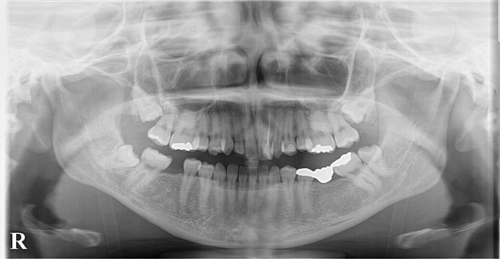 歯欠損の矯正治療前口内写真NO.128