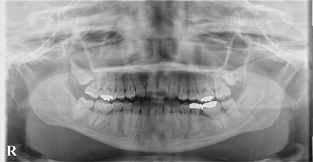 歯欠損の矯正治療後口内写真NO.128