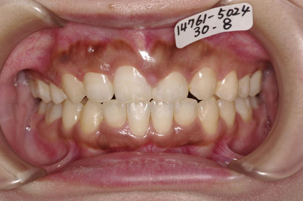 歯欠損の矯正治療後口内写真NO.129